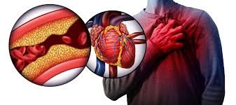 Heart disease chronic disease
